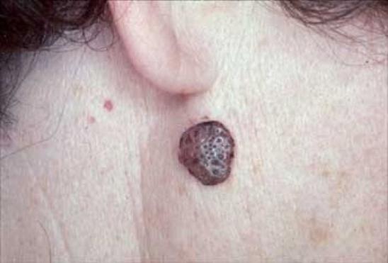 Seborrhoeic Keratosis4